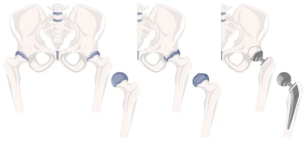 Problema con los huesos de la cadera — Vector de stock