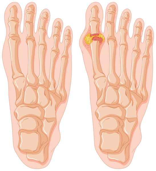 Diagram of gout in human toe