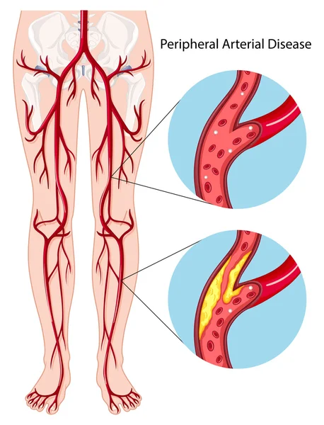 Diagrama de enfermedades arteriales periféricas — Archivo Imágenes Vectoriales