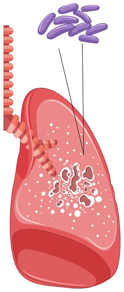 Batteri nei polmoni umani — Vettoriale Stock