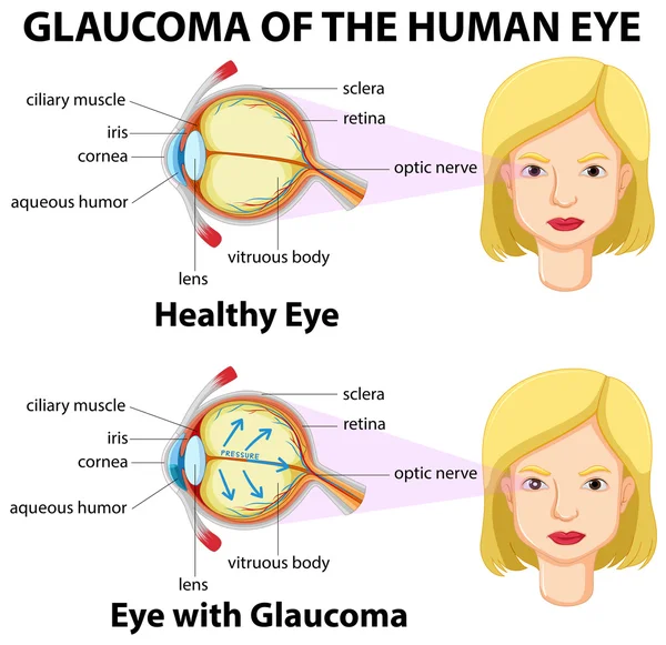 Glaucoom van het menselijk oog — Stockvector