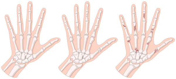 Diagramme montrant la fracture de la main — Image vectorielle