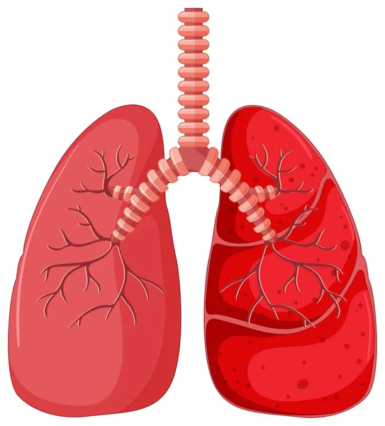 Diagrama pulmonar con neumonía — Archivo Imágenes Vectoriales