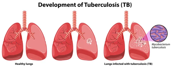 Gráfico que muestra el desarrollo de tuberculosis — Archivo Imágenes Vectoriales