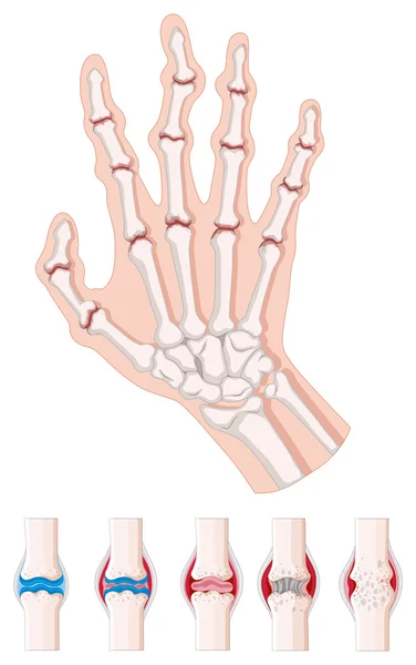 Rheumatoid arthritis diagram on white — Stock Vector