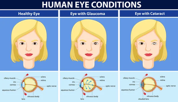 Diagram showing human eye conditions — Stock Vector