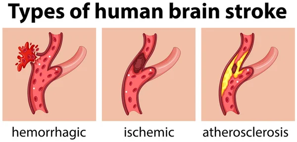 Tipos de accidente cerebrovascular humano — Archivo Imágenes Vectoriales