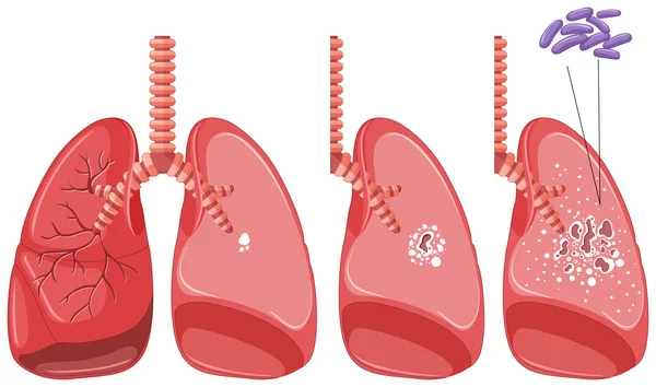 Tuberculose in de menselijke longen — Stockvector