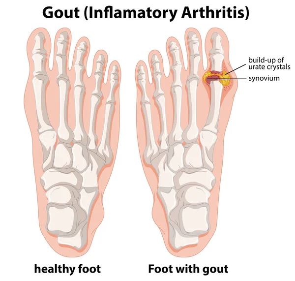 Diagram explanation of Gout in human foot — Stock Vector