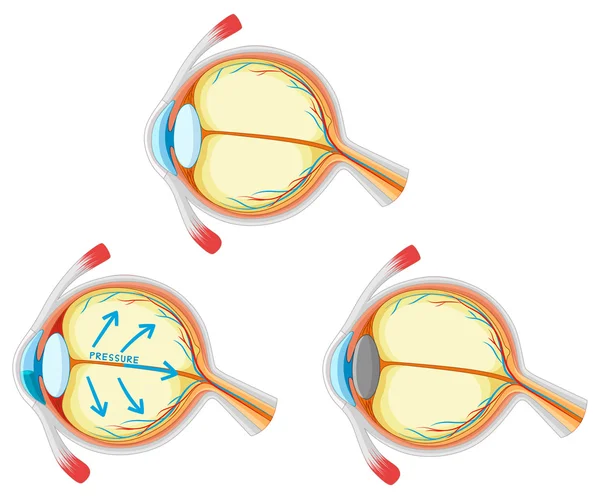 Diagramme montrant la maladie des yeux — Image vectorielle
