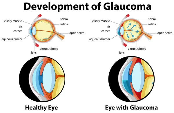 Diagrama que muestra el desarrollo del glaucoma — Vector de stock