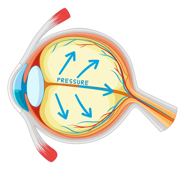 Enfermedad de los ojos en mirada más cercana — Vector de stock