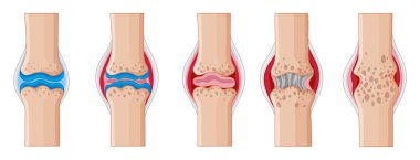 Rheumatoid arthritis in human joints clipart