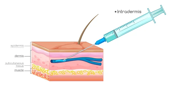 Diagrama mostrando a injeção da agulha na pele — Vetor de Stock