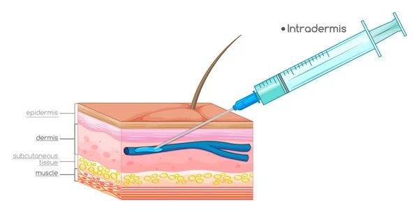 Diagram menunjukkan suntikan jarum pada kulit - Stok Vektor