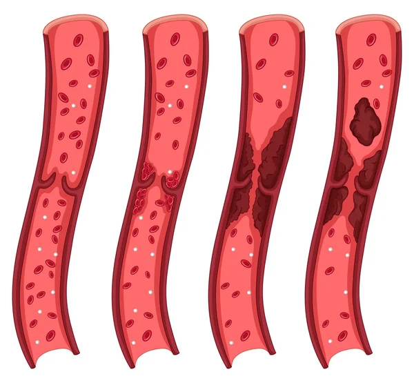 Schéma de caillot sanguin sur blanc — Image vectorielle