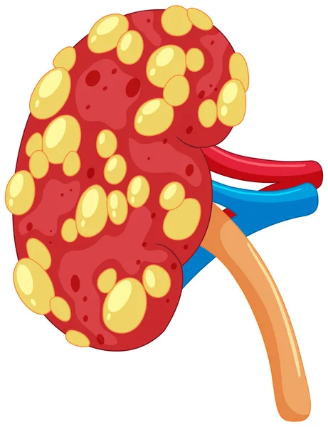 Cerrar riñón con enfermedad — Archivo Imágenes Vectoriales