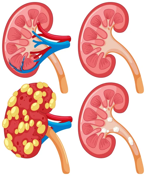 Diagrama de riñón con enfermedad — Vector de stock