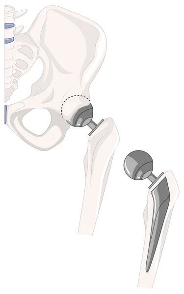 Tratamiento del hueso de la cadera humana — Vector de stock