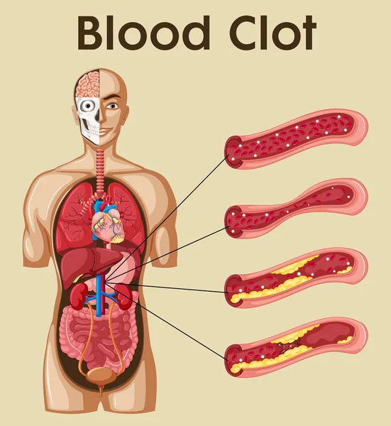 Diagrama mostrando coágulo sanguíneo em humanos —  Vetores de Stock