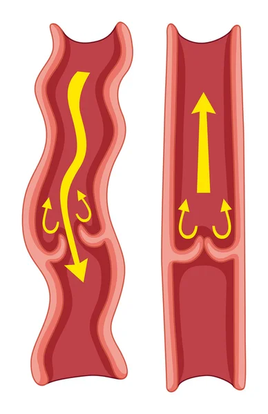 Vene varicose nel corpo umano — Vettoriale Stock