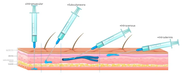 Diagram som visar injektion med spruta — Stock vektor