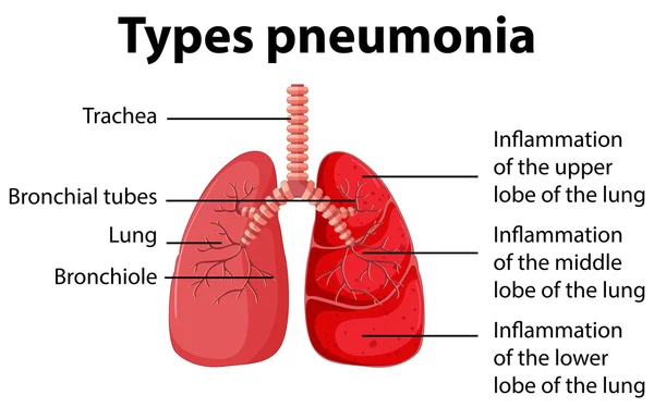 Diagram menunjukkan jenis pneumonia - Stok Vektor