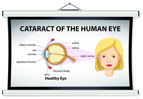인간의 눈에 백 내장의 다이어그램 — 스톡 벡터