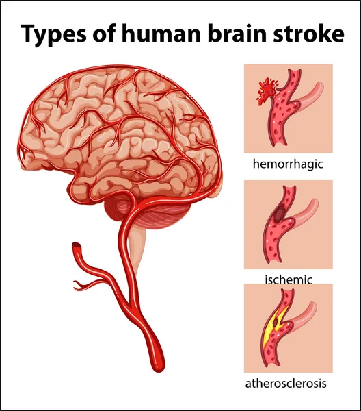 Typer av mänskliga hjärnan stroke — Stock vektor