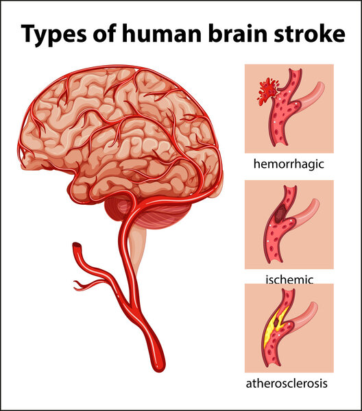 Types of human brain stroke