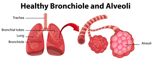 Diagram met gezonde Bronchiolus en longblaasjes — Stockvector