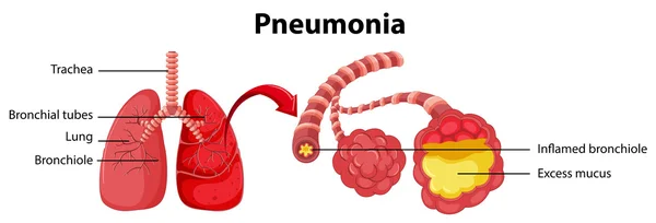 Diagramma che mostra polmone con polmonite Vettoriale Stock