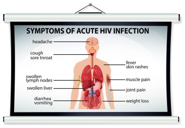 Akut HIV enfeksiyonu belirtileri gösteren grafik