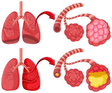 Human lungs with pneumonia clipart