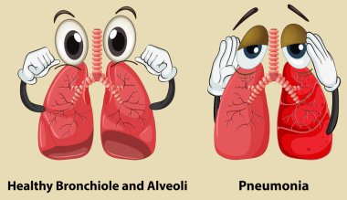 Diagram showing healthy and pneumonia lungs clipart