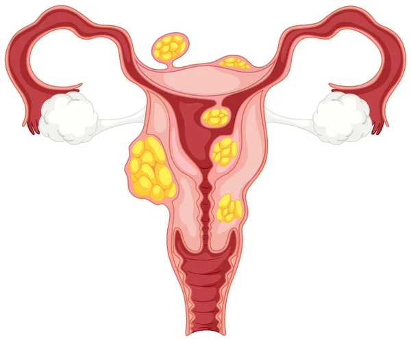 Diagram of subserosal uterine fibroids — Stock Vector
