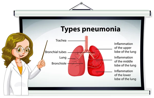 Врач объясняет типы пневмонии — стоковый вектор