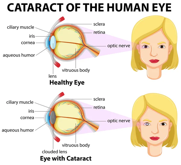 Diagrama que muestra los ojos con cataratas — Vector de stock