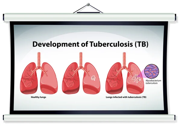 Grafiek met ontwikkeling van tuberculose — Stockvector