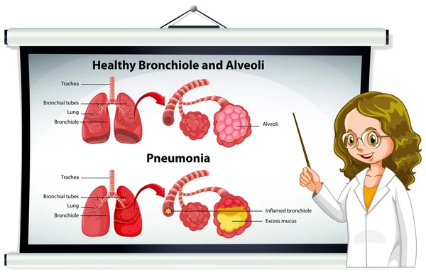 Médico explicando bronquiolo sano y alvéolos — Archivo Imágenes Vectoriales
