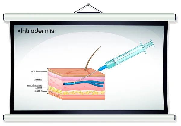 Intradermis 주입을 보여주는 다이어그램 — 스톡 벡터