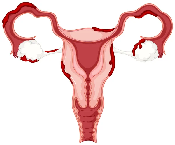Diagrama de ovário de mulher com endometriose — Vetor de Stock