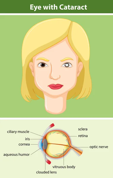 Diagram menunjukkan mata dengan katarak - Stok Vektor