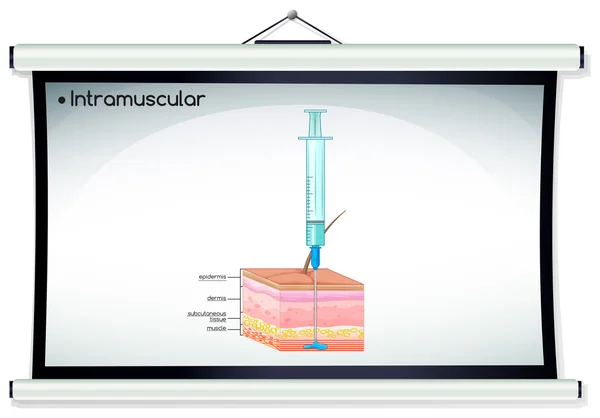 Injeção intramuscular no quadro branco —  Vetores de Stock