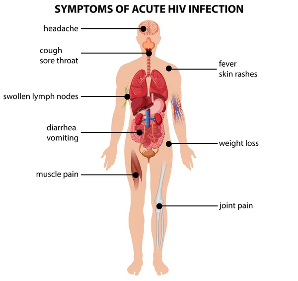 Akut HIV enfeksiyonu belirtileri gösteren diyagram — Stok Vektör