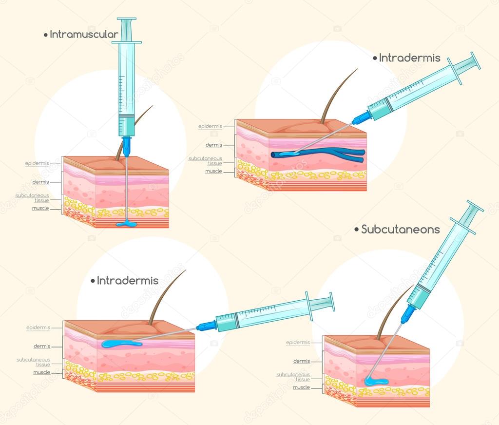 Injection Types