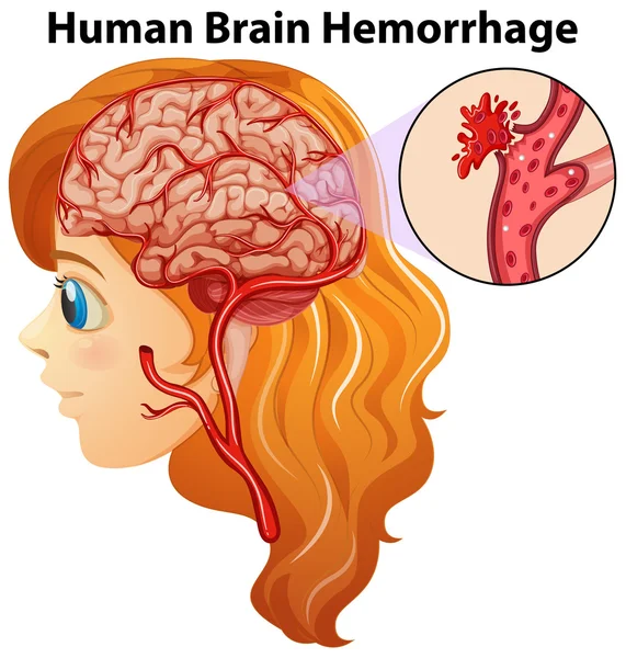 Diagram showing human brain hemorrhage — Stock Vector