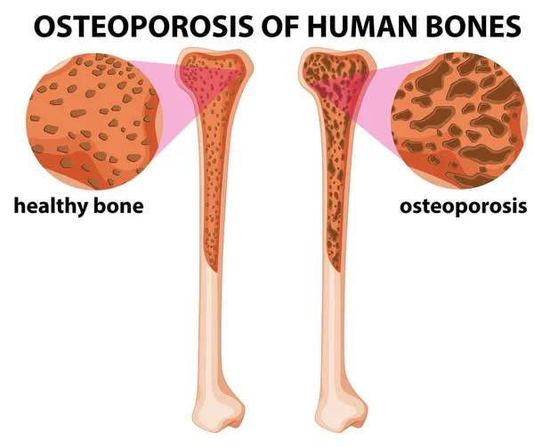 Diagram showing osteoporosis of human bones — Stock Vector