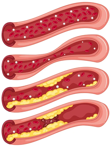 Schema che mostra coagulo di sangue nelle vene umane — Vettoriale Stock