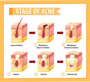 Stages of skin acne anatomy illustration clipart